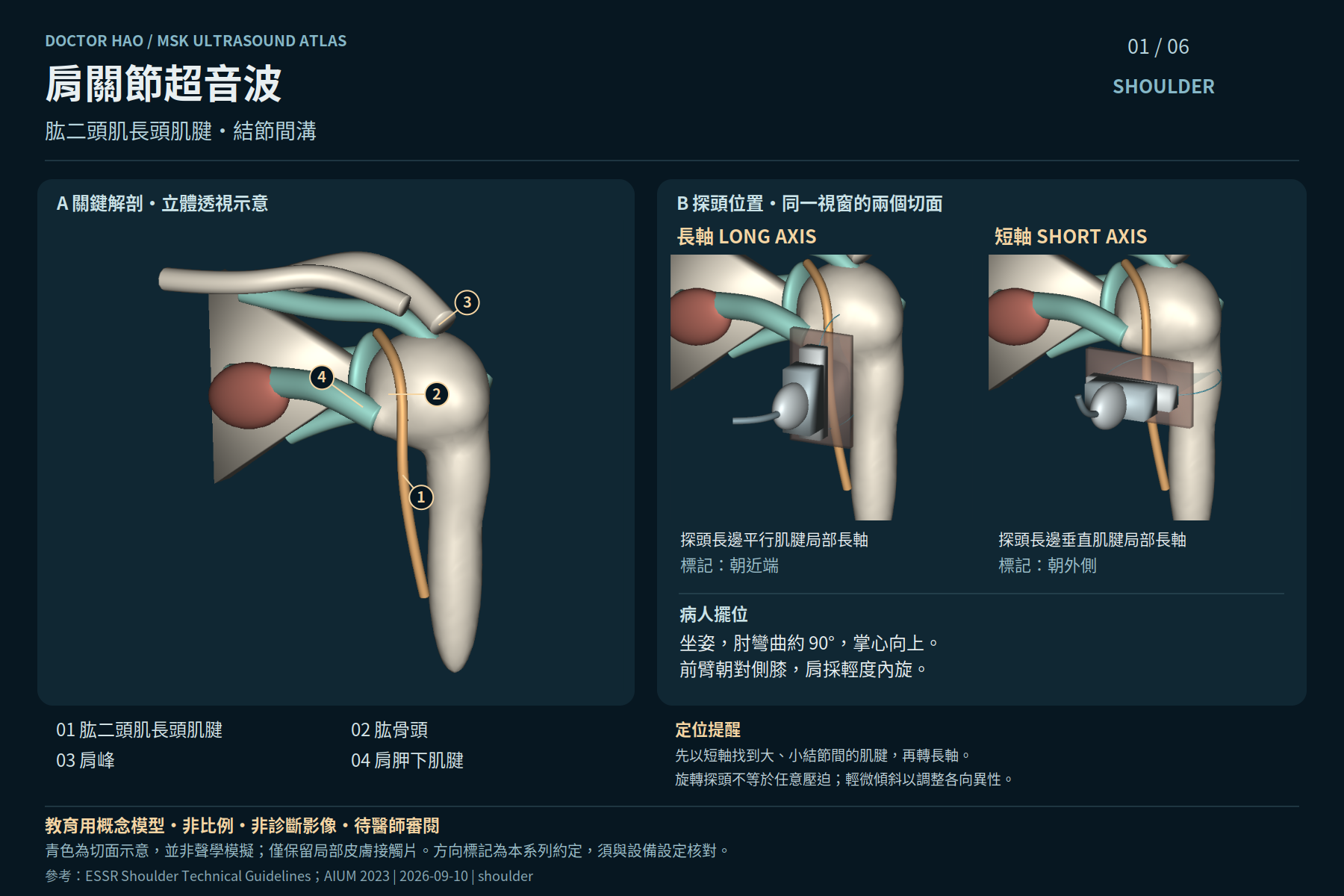 以結節間溝為骨性地標辨識肱二頭肌長頭肌腱;此圖不等於完整旋轉肌袖檢查。